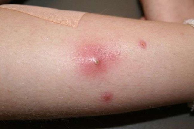 बालतोड़ के घरेलू नुस्खे