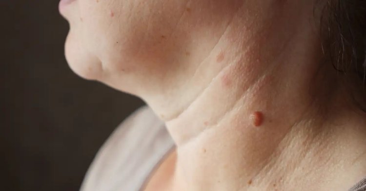 त्वचा में मौजूद मस्सों से कैसे पाएं राहत, जानिए टिप्स