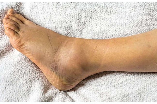 पांव में मोच आने के बाद क्या करें - क्या नहीं करना चाहिए