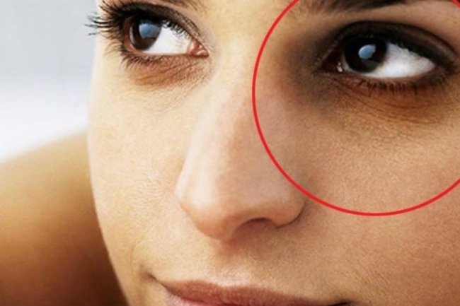 आंखों के आस-पास पड़ी इन झुर्रियों से दिख सकते हैं बूढ़े, जानें रोकने के उपाय